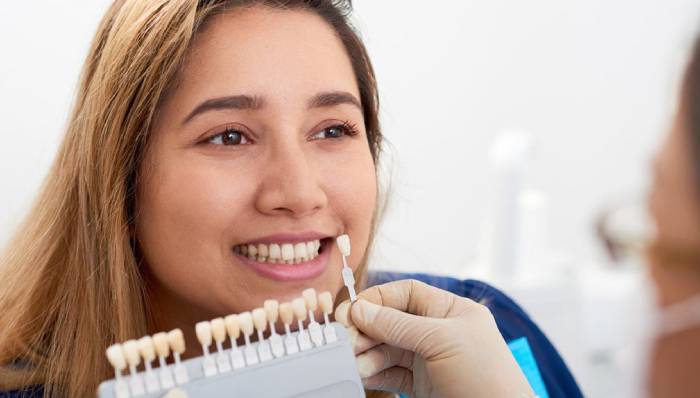Dental Veneers