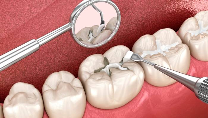 Fillings