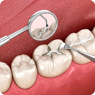 Fillings