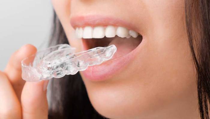 Orthodontic Aligners