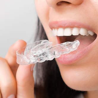 Orthodontic Aligners