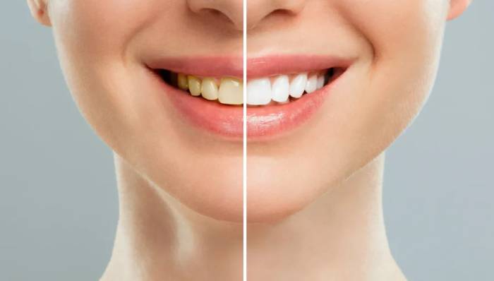 Teeth Whitening
