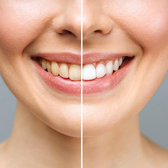 Teeth Whitening