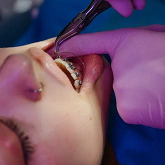 Traditional Braces