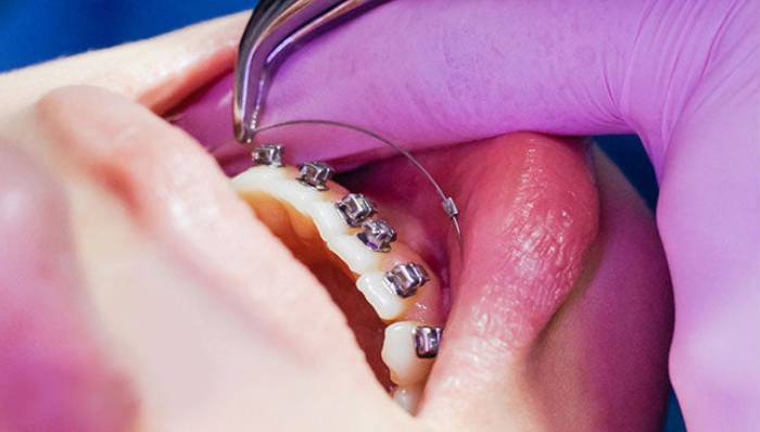 Traditional Braces