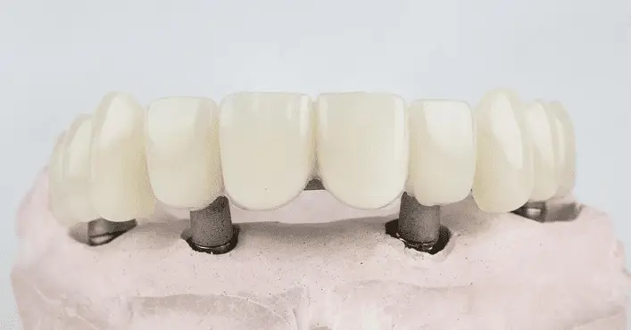Dental Bridges