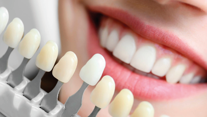 Dental Bonding