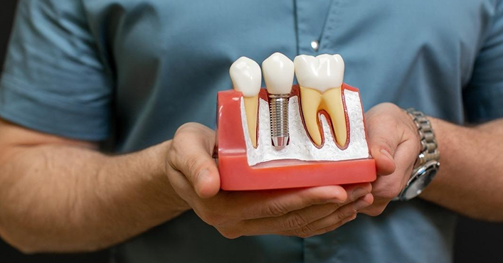 Dental Implants