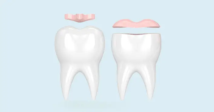 Dental Inlays and Onlays