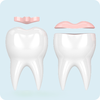 Dental Inlays and Onlays