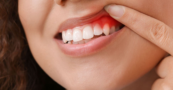 Gum Disease Treatment