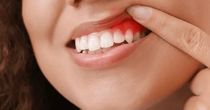 Gum Disease Treatment