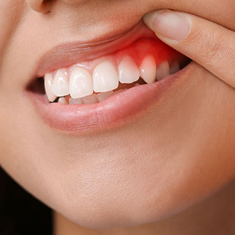 Gum Disease Treatment
