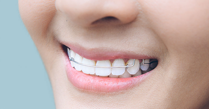 Orthodontic Retainers
