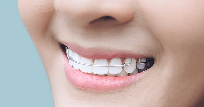 Orthodontic Retainers