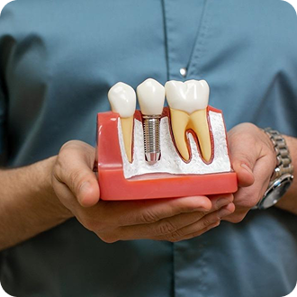 Dental Implants