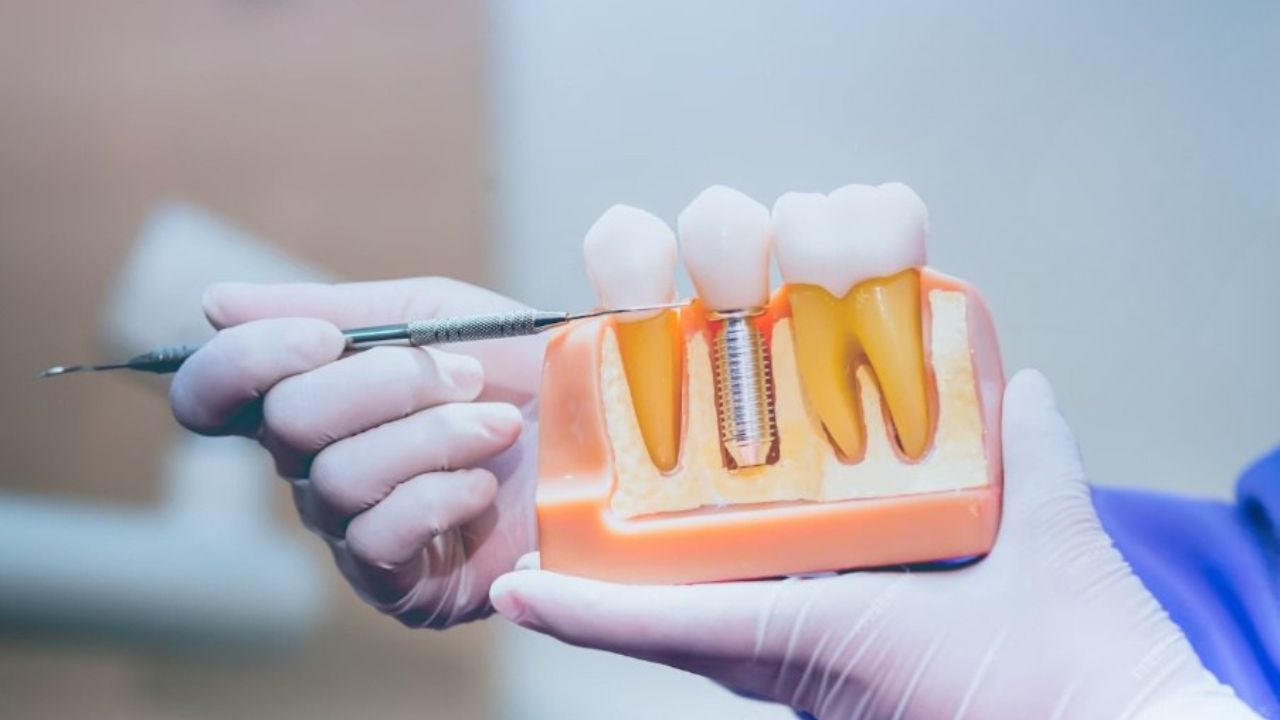 How long do dental implants last
