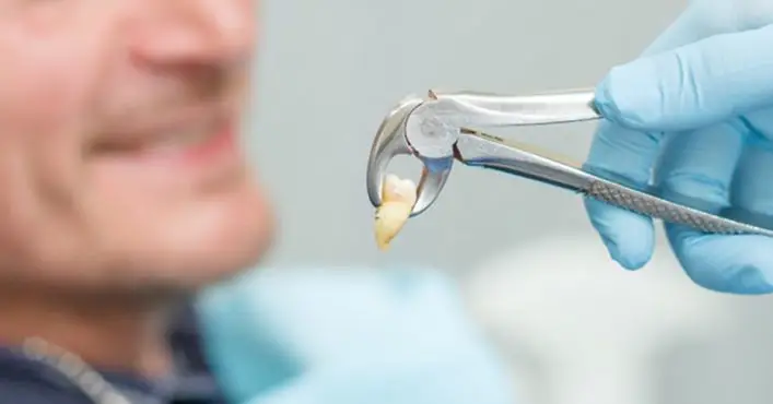 Tooth Extractions