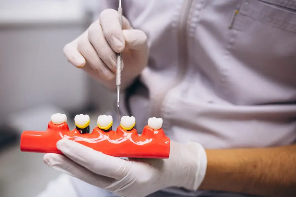 Dental Implants