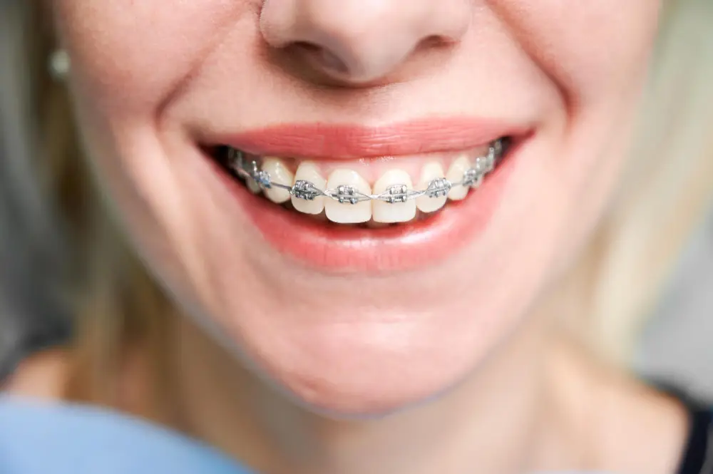 Dental bonding with braces