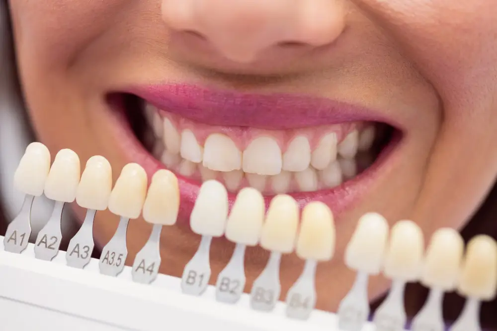 How Many Dental Veneers Do You Actually Need