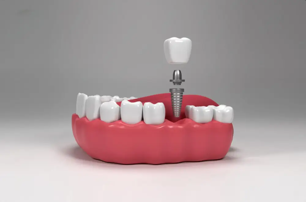 Do Dental Implants Feel Like Real Teeth?