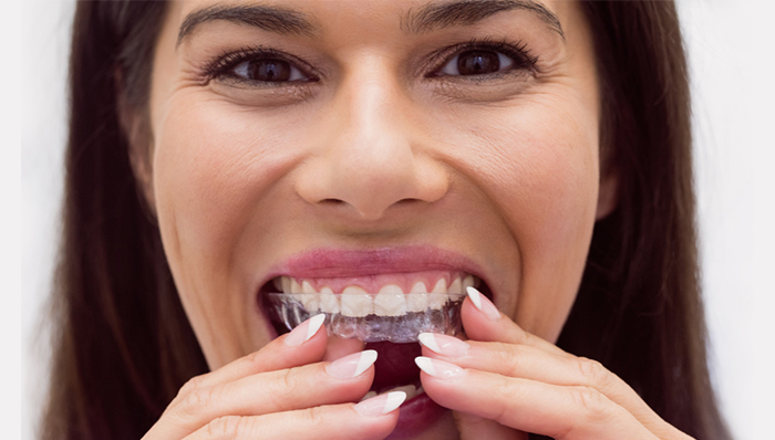 Invisalign