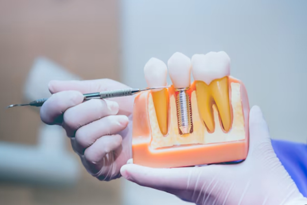 Dental implant model used to explain signs of a dental implant infection